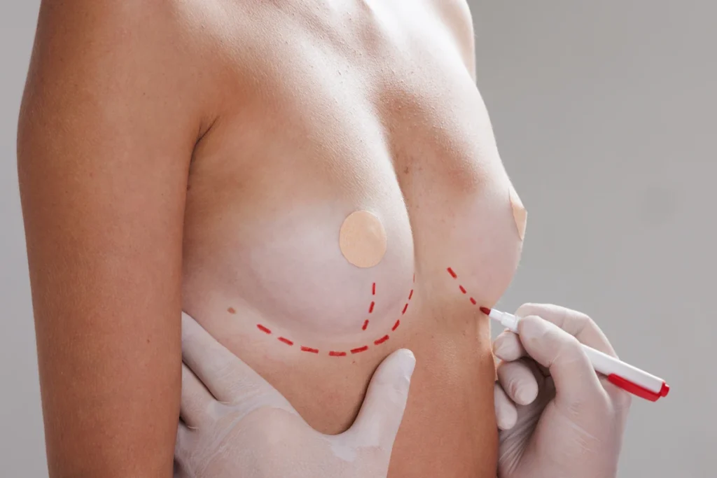 Une femme qui se fait tracer par un médecin en dessous des seins