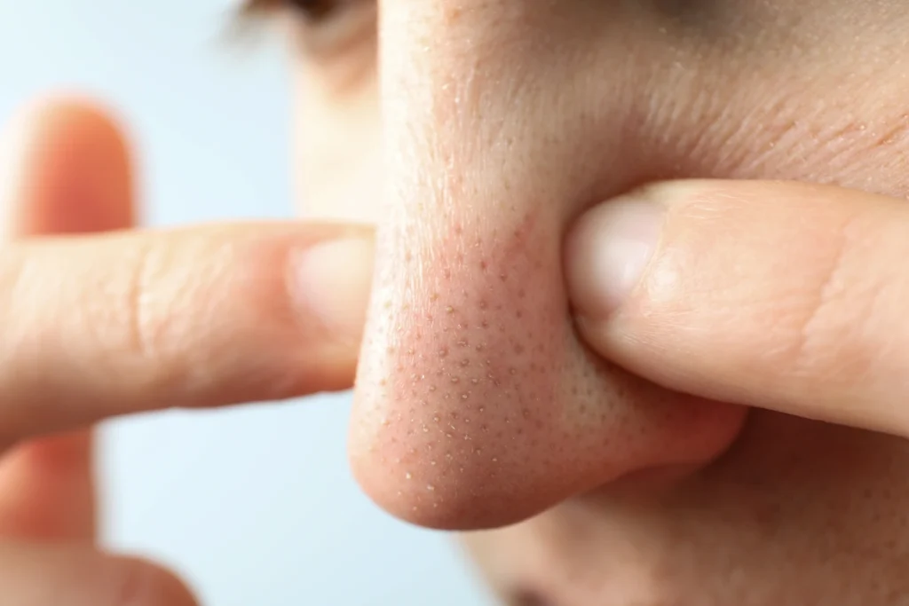 Un homme qui presse son nez avec les doigts